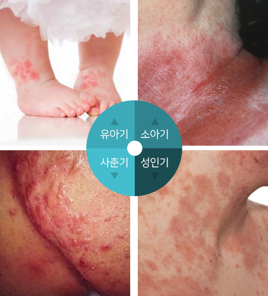 유아기,소아기,사춘기,성인기 아토피 이미지